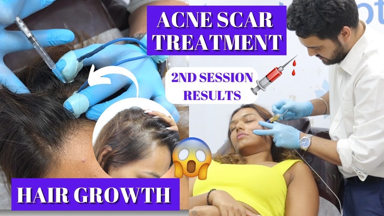 Hair Growth & Acne Scar 2nd Treatment Results! Sarah Sarosh