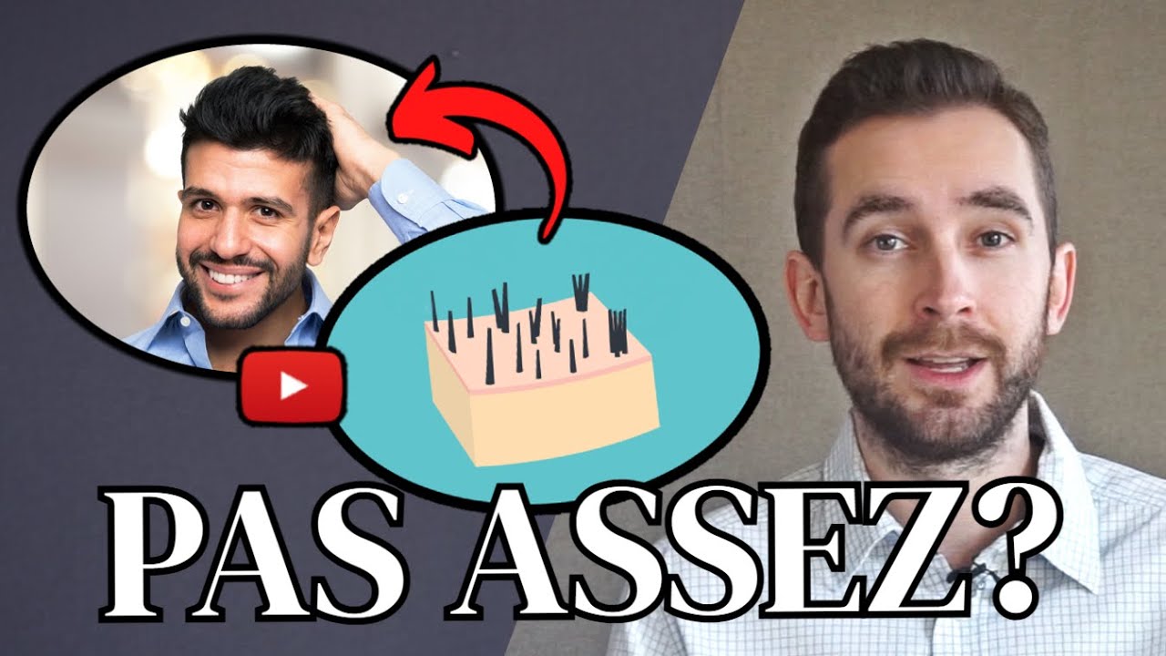 Combien de greffons faut-il pour une greffe de cheveux ? [CONSEIL D'EXPERT]