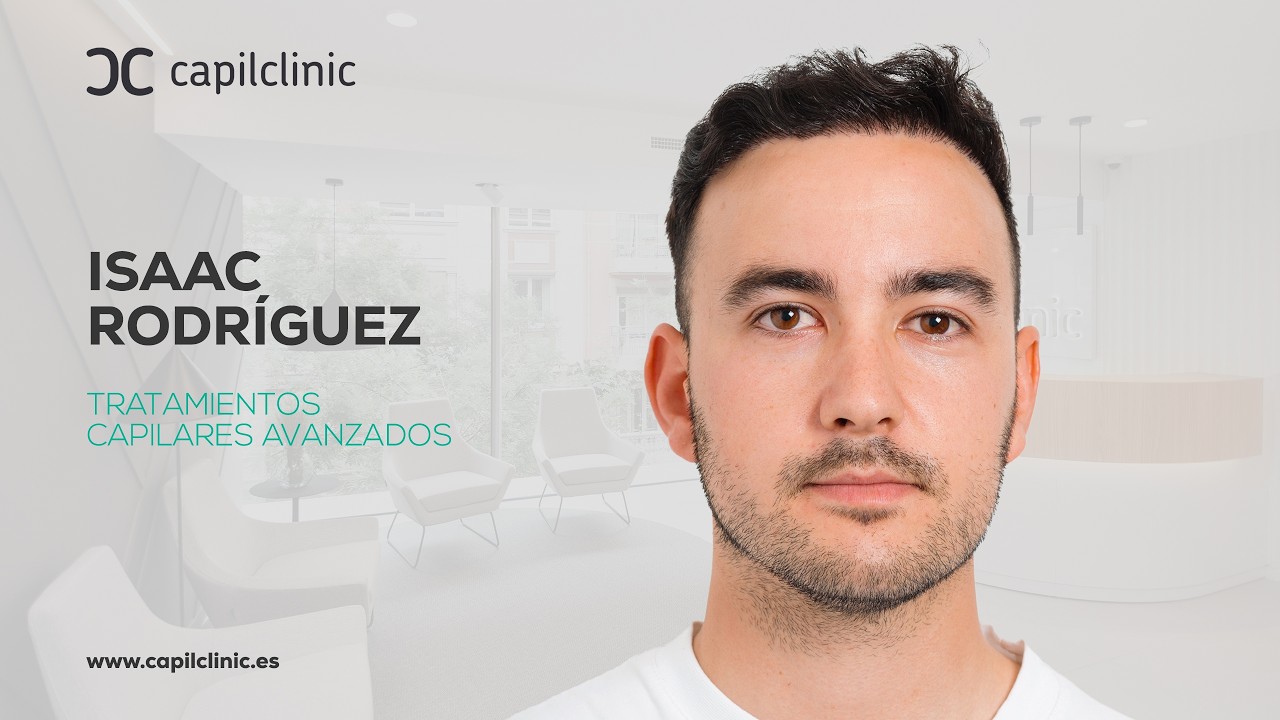 Alopecia a los 17 | Capilclinic trasplante capilar antes y después