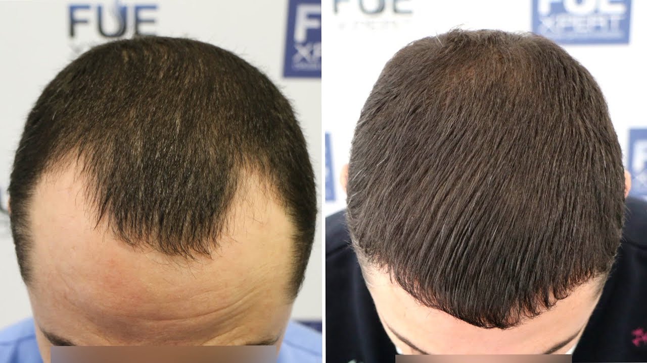 FUE Hair Transplant (2540 Grafts in NW Class 3-A) By Dr Juan Couto - FUEXPERT CLINIC, Madrid, Spain