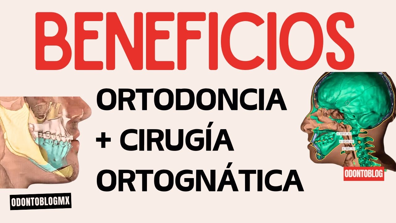 Beneficios de Ortodoncia + Cirugía Ortognática