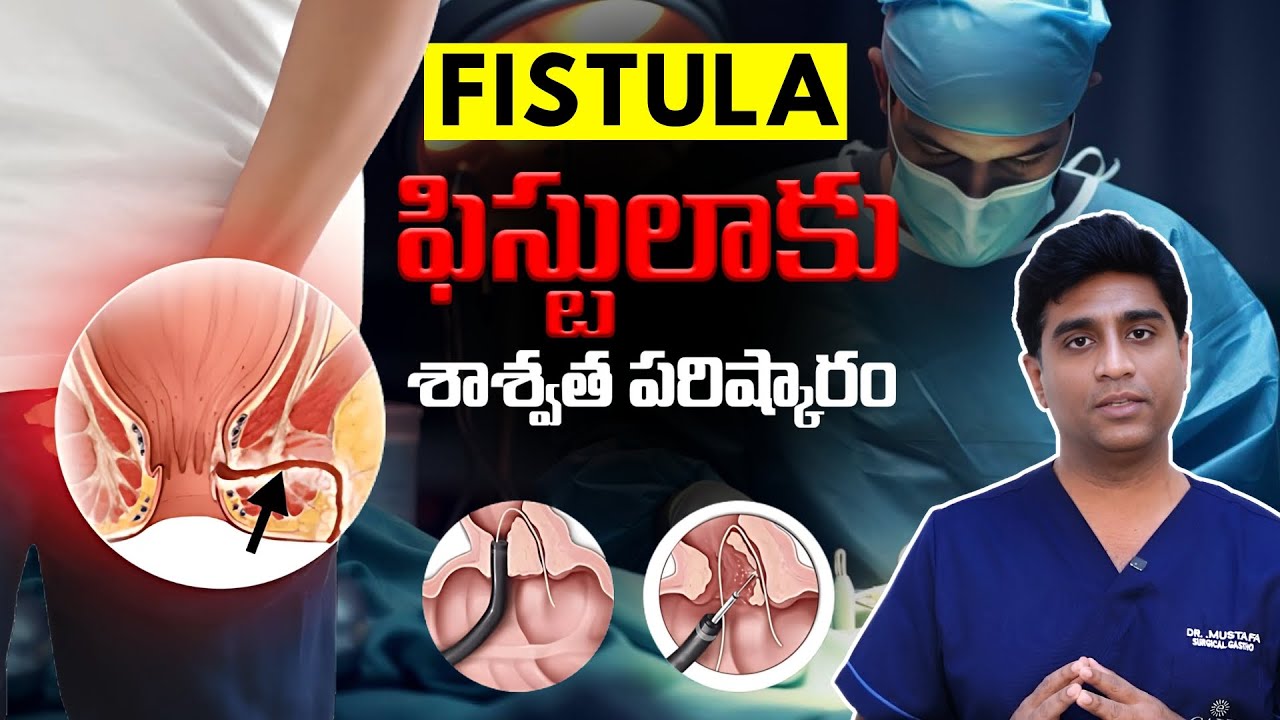 ఫిస్టులాకు లేజర్ ట్రీట్మెంట్ | Laser treatment for fistula in telugu | Fistula telugu | Dr Mustafa