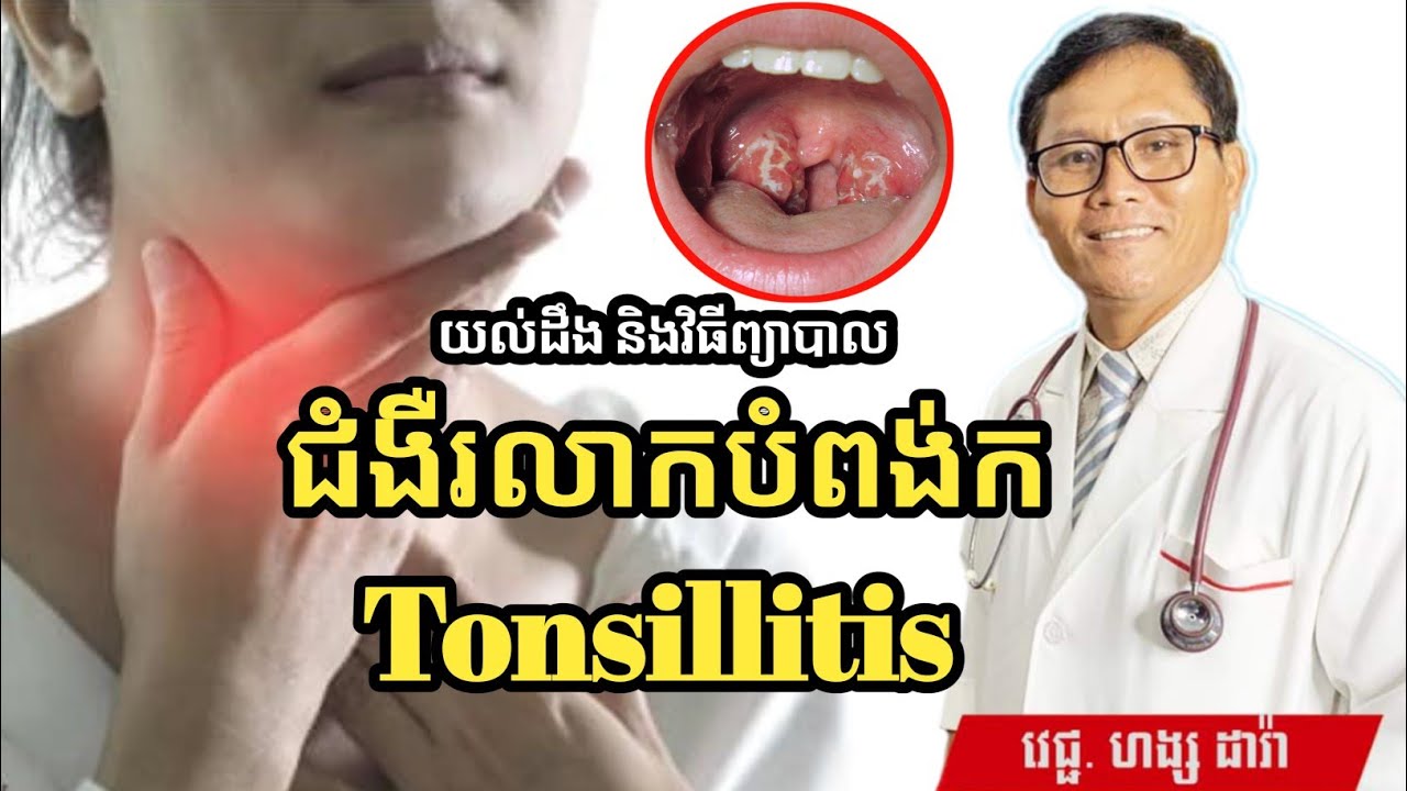 ជំងឺរលាកបំពង់ក Tonsillitis និងវិធីព្យាបាល | វេជ្ជបណ្ឌិត ហង្ស ដារ៉ា | success knowledge