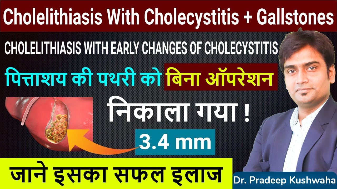 cholelithiasis with cholecystitis | cholecystitis treatment without surgery  hindi| गॉलब्लैडर स्टोन
