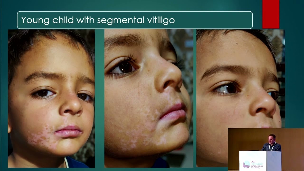 Targeted Phototherapy in Vitiligo