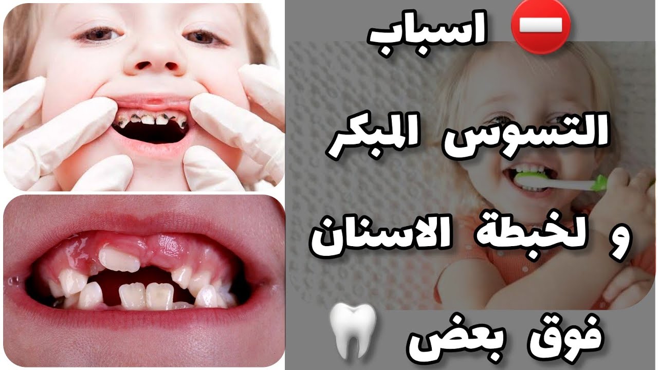 ⛔️ كارثة #تسوس اسنان طفلك قبل ميعاد تبديلها🦷تسوس الرضاعة‼️أسباب لخبطة الاسنان فوق بعض🥺