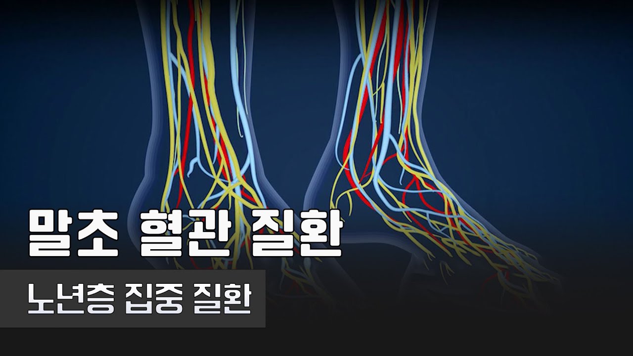 노년층 집중 발생, 말초혈관질환 | 말초 혈관 질환 | 건양대학교 병원 외과 김민규 교수 | 건강플러스