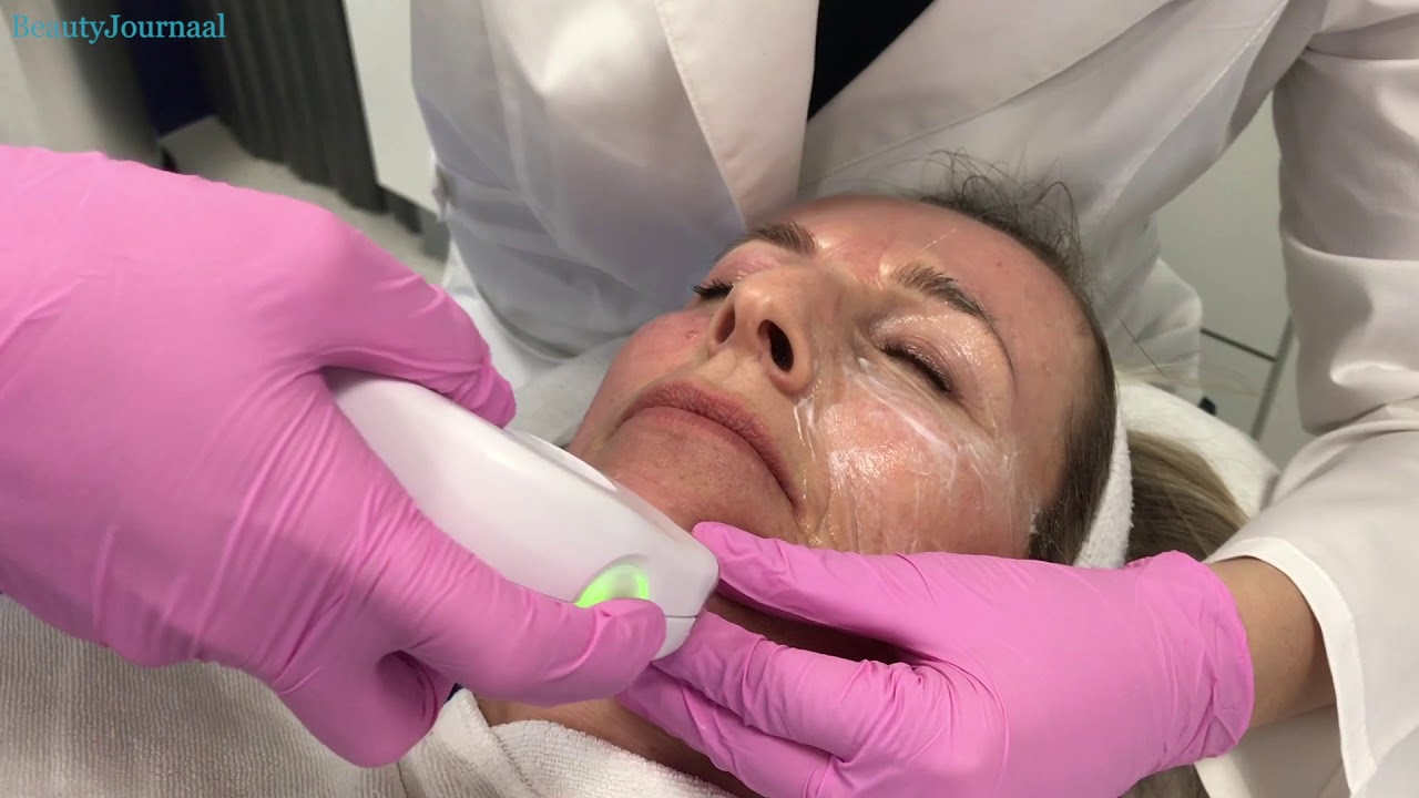 Odile krijgt de Endymed 3DEEP radiofrequentie behandeling tegen rimpels