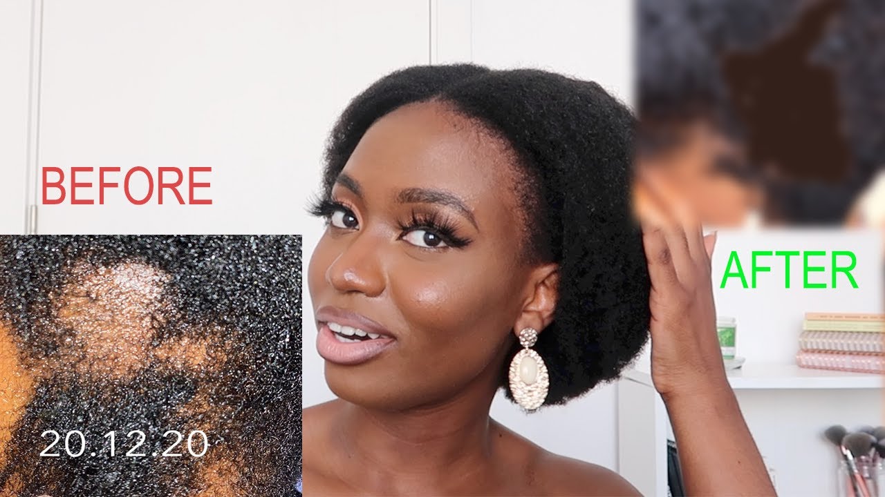 How I Grew My Bald Spot on my 4C NATURAL HAIR in 2 Months WITH PICTURES