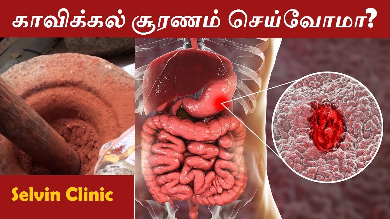 KAVIKKAL CHOORANAM I SIDDHA TRATIONAL MEDICINE PREPARATION I அல்சர் நோய்க்கு I LIVE I Selvin Clinic