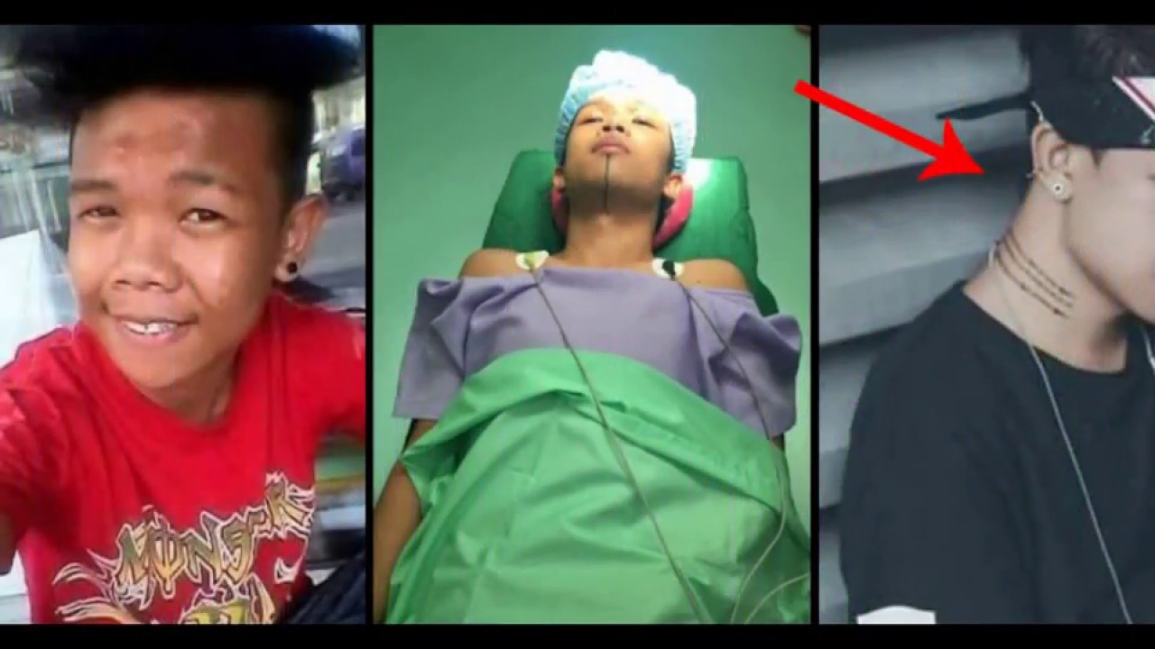 XANDER FORD - BEFORE AND AFTER SURGERY