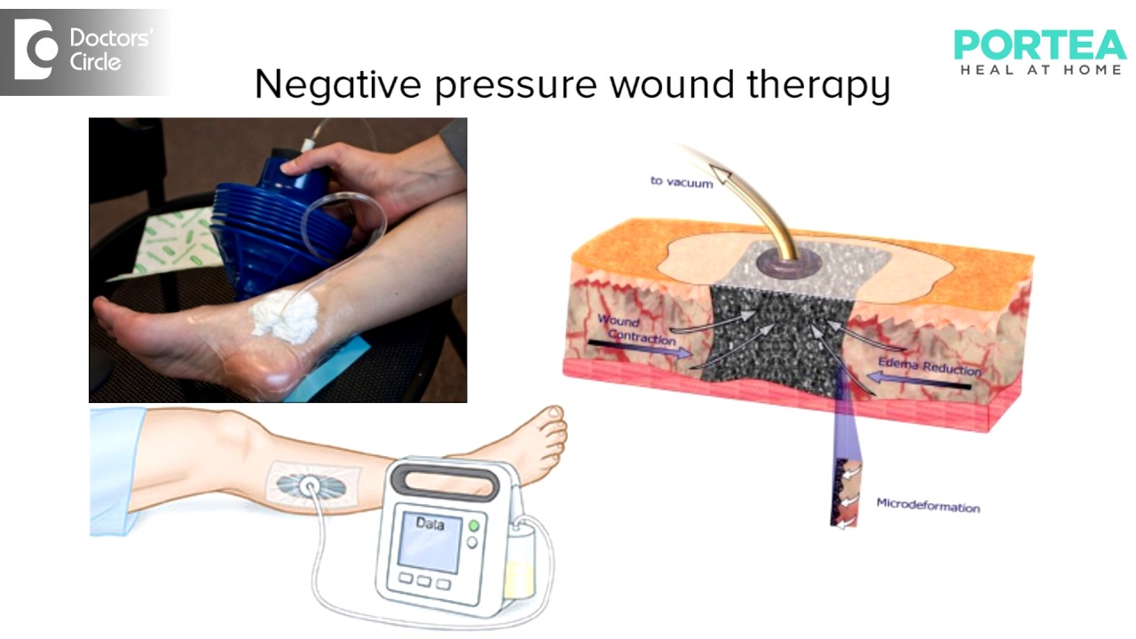 What is meant by negative pressure wound therapy? | Portea Medical