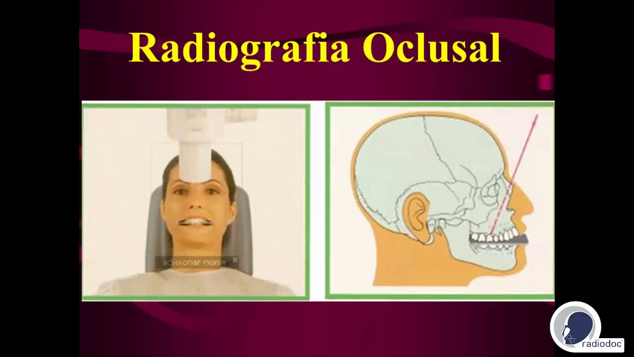 Radiografia Oclusal - Radiodoc