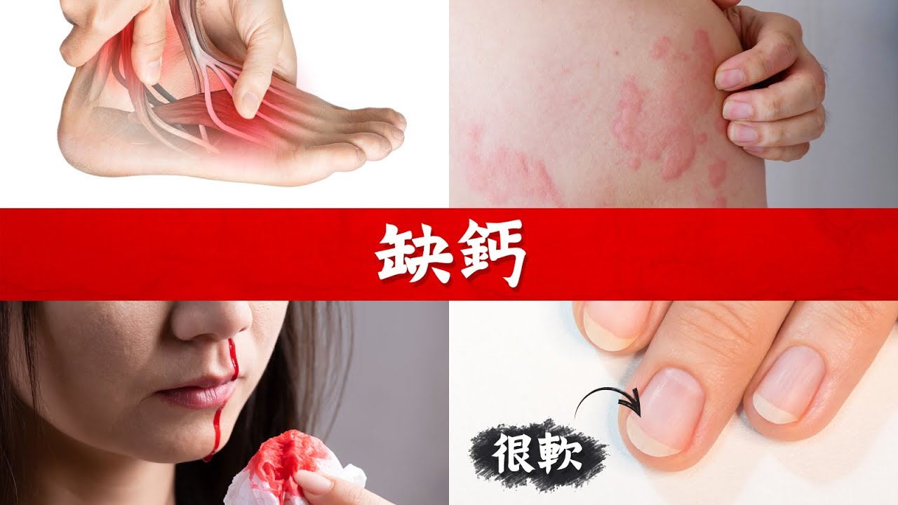 缺鈣各種原因,自我測試,柏格醫生 Dr Berg