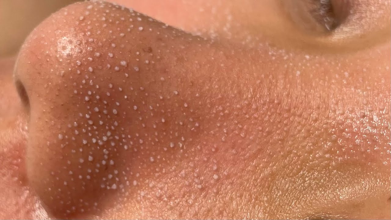 【韓国式3D毛穴洗浄】毛穴の角栓黒ずみをごっそり吸引 ASMR Blackheads