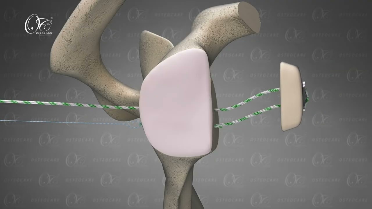 Bone block procedure with osteocare system 