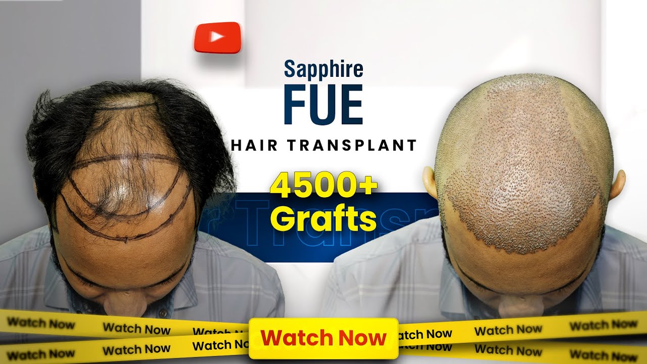 Hair Transplant Surgery Day | 4500 Grafts | Grade 4 Baldness | Hairfree & Hairgrow Bangladesh