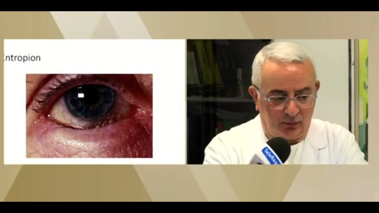 Patologie palpebrali: ectropion, entropion, blefarocalasi se ne parla con il dr. FANTI a Villa Verde