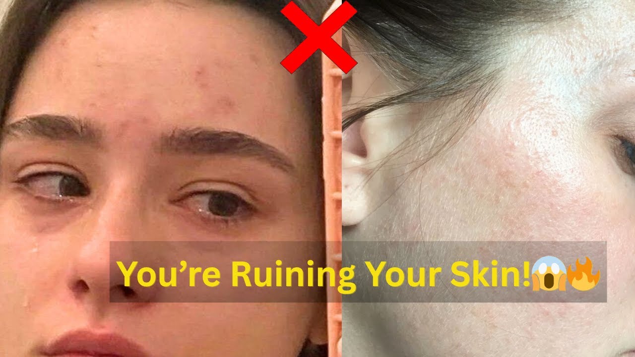 Summer Skincare Mistakes Every Teen Should Avoid ☀️💧 No More Breakouts!