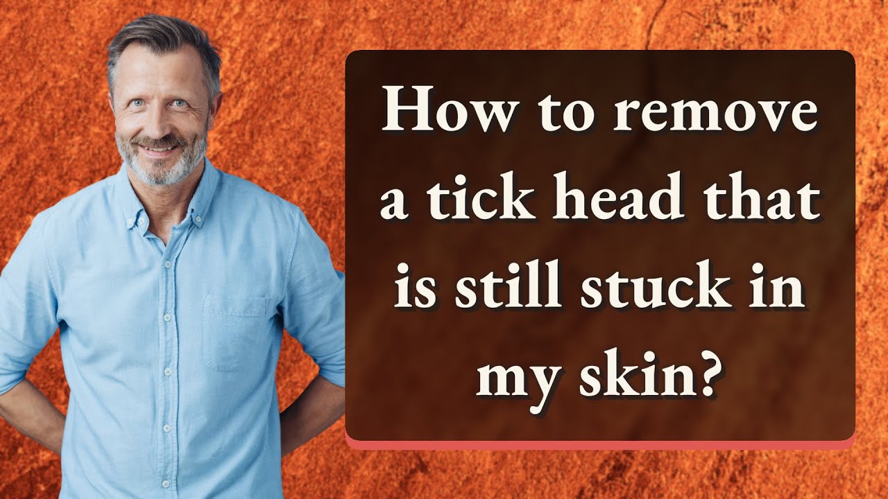 How to remove a tick head that is still stuck in my skin?
