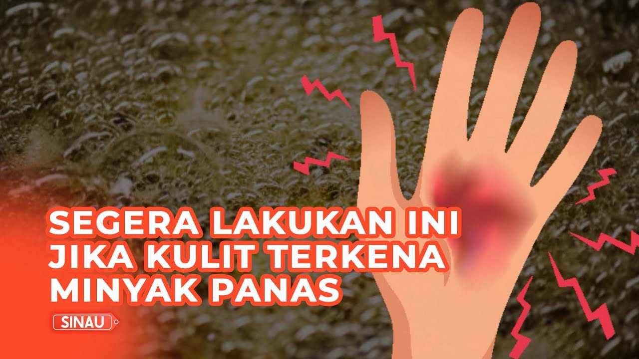 Cara Alami Mengobati Luka Terkena Percikan Minyak Panas, Apa Saja?