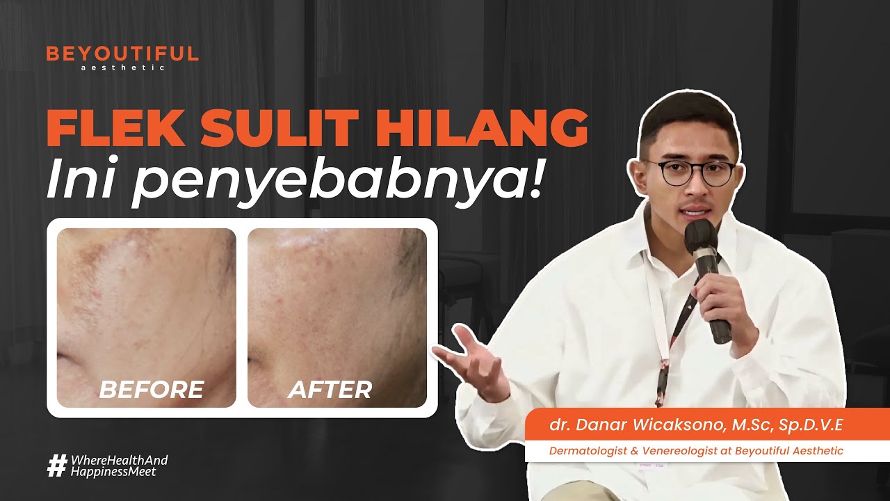 Treatment Ini Terbukti Menghilangkan Melasma!