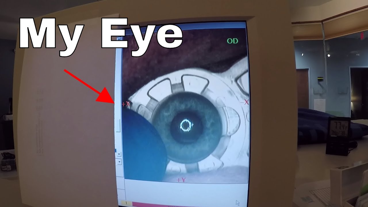 I Filmed my Lasik Eye Surgery&mdash;A Step by Step Guide to Lasik