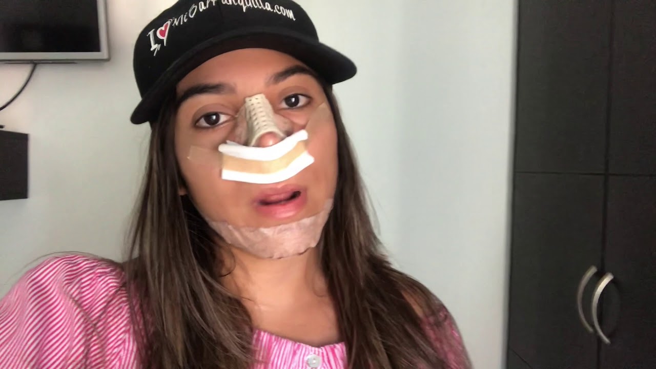 Rinoplastia SIN MORADOS? - Primera Semana Post - Rinoplastia