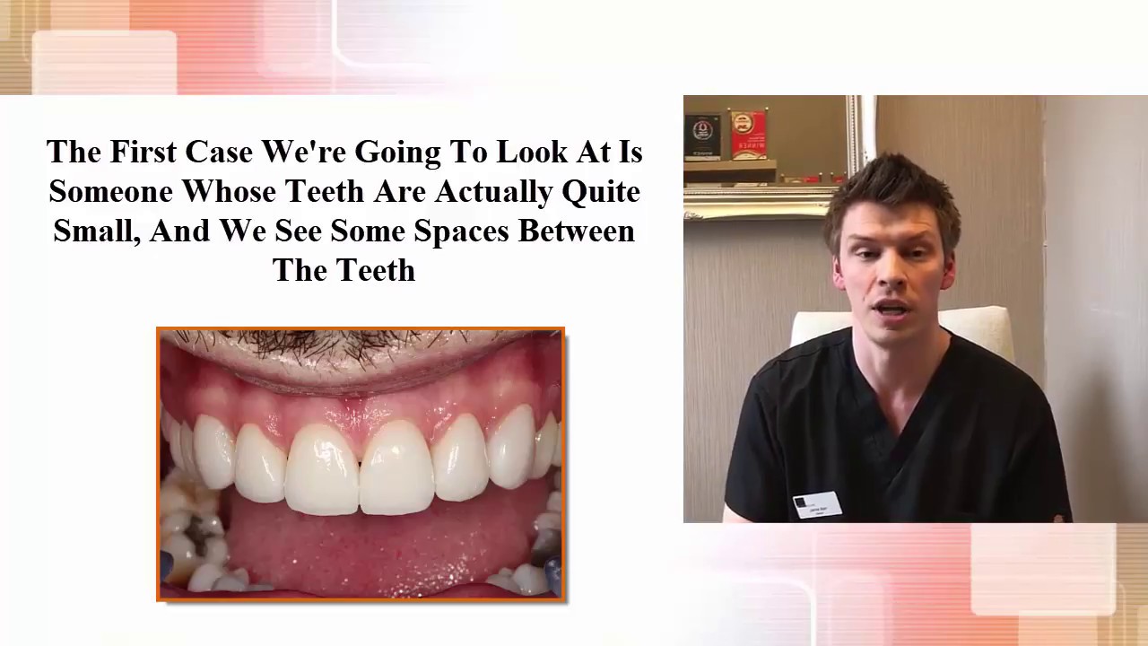 Are You Suitable For Dental Veneers?