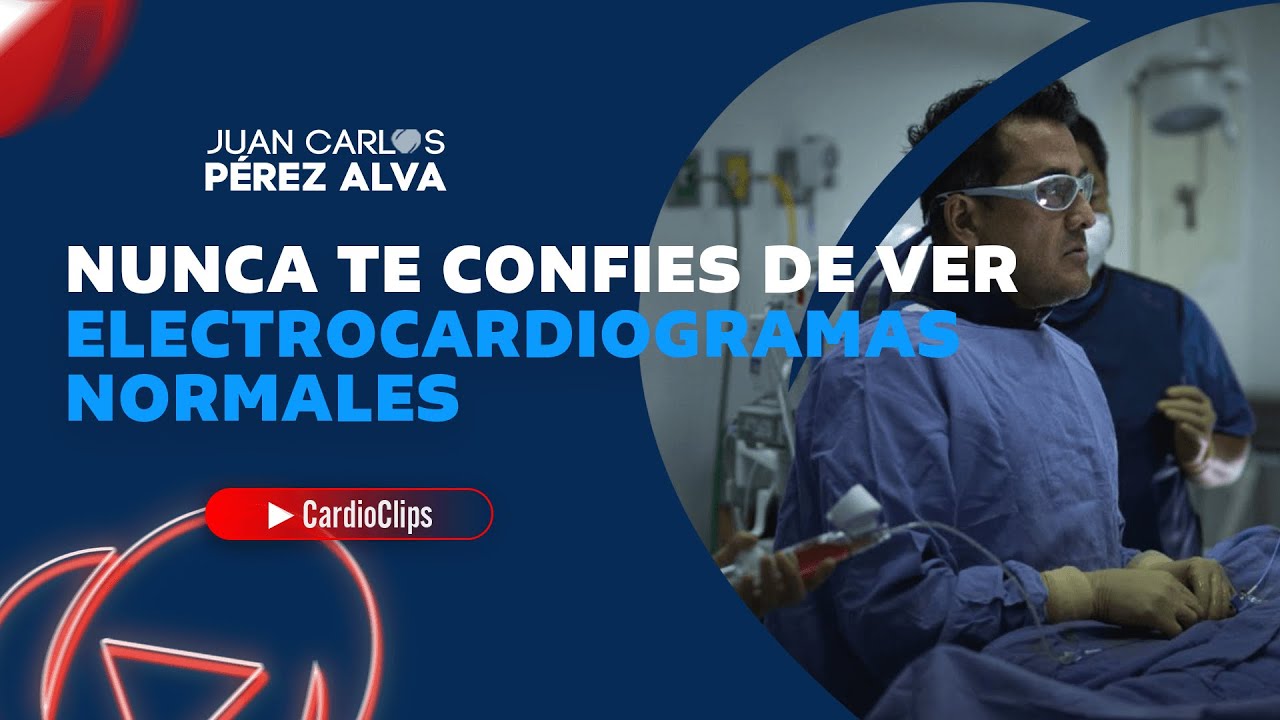 NUNCA CONFIES AL VER ELECTROCARDIOGRAMAS NORMALES