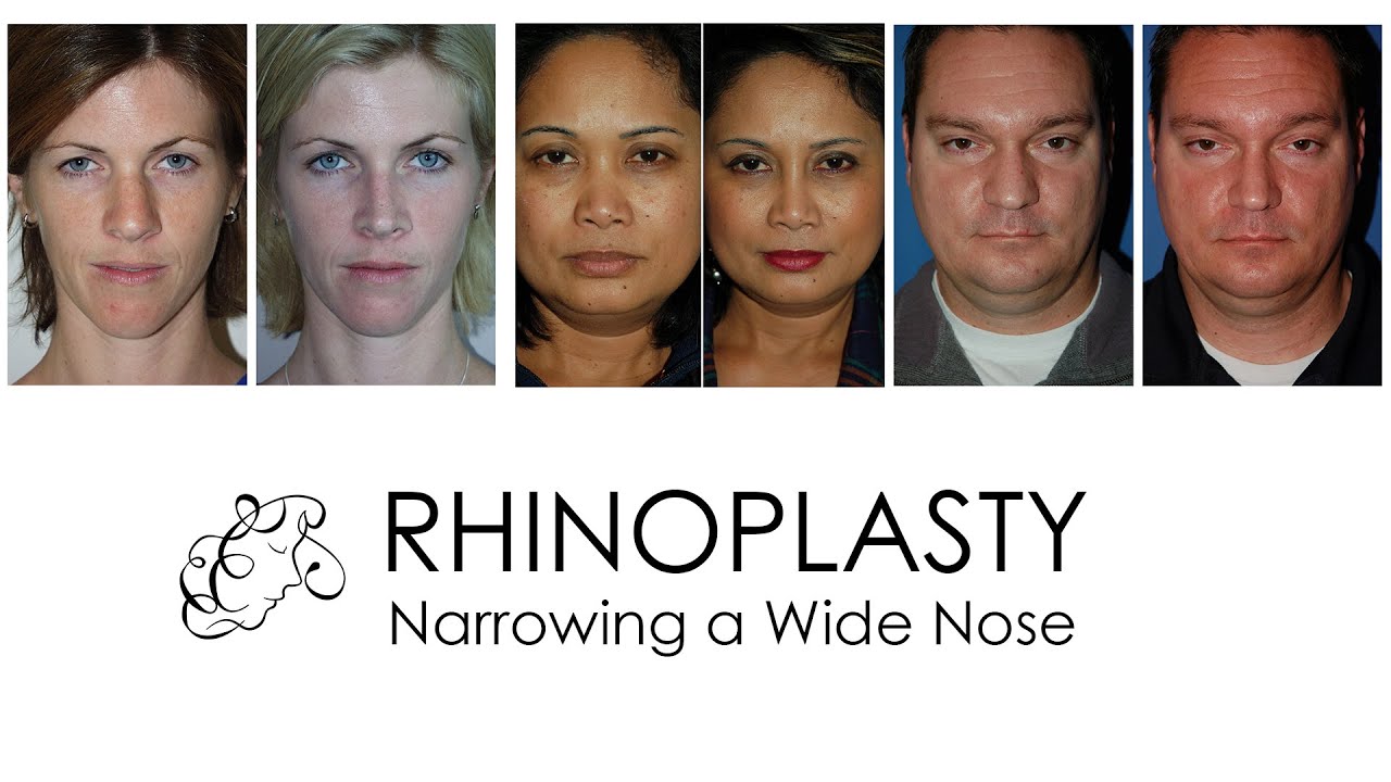 Rhinoplasty - How can a wide nose be narrowed