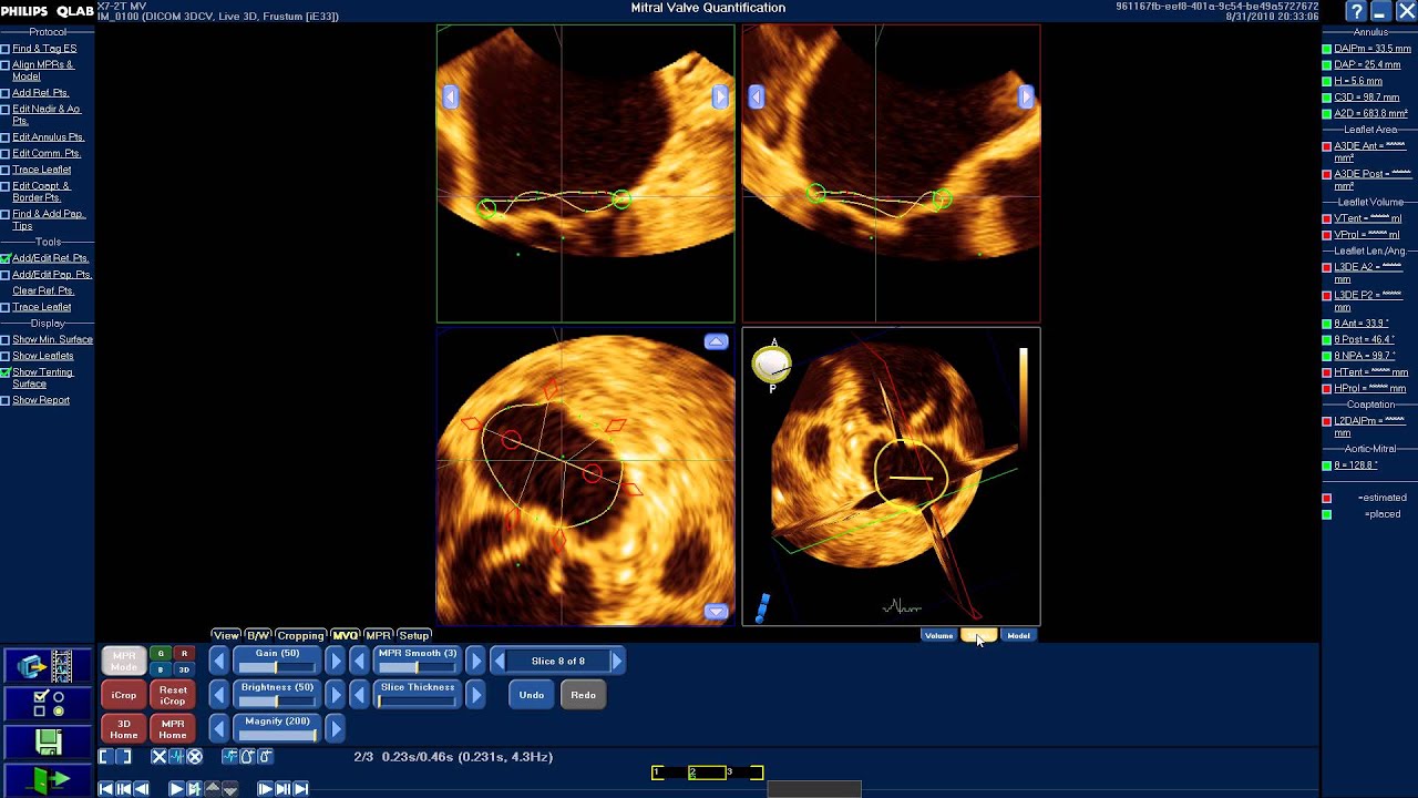 How to use Mitral Valve Quantification (MVQ) software of Q-Lab