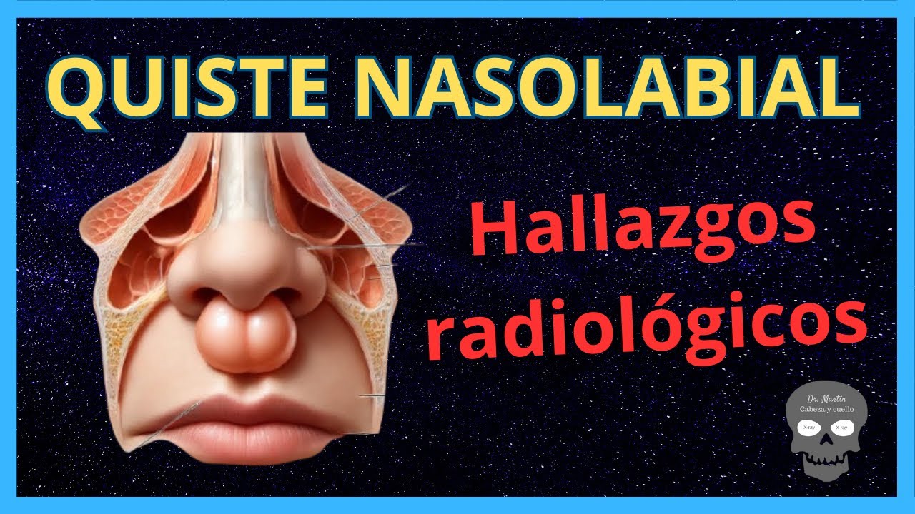 🔎 Quiste Nasolabial: 🩻 Diagnóstico y Hallazgos Radiológicos Explicados 📊