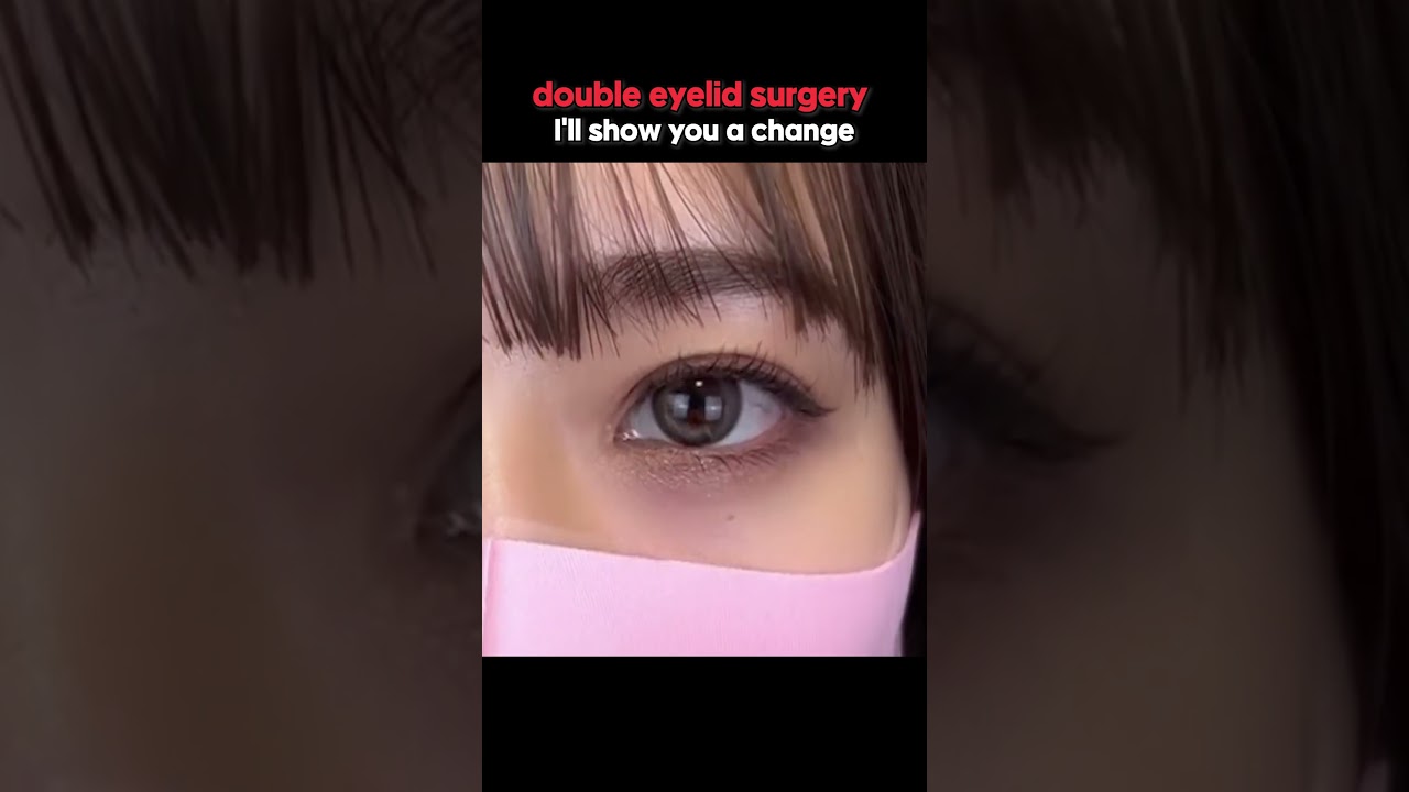 Double Eyelid Surgery &ndash; Life-Changing or Overrated? 🙃😲