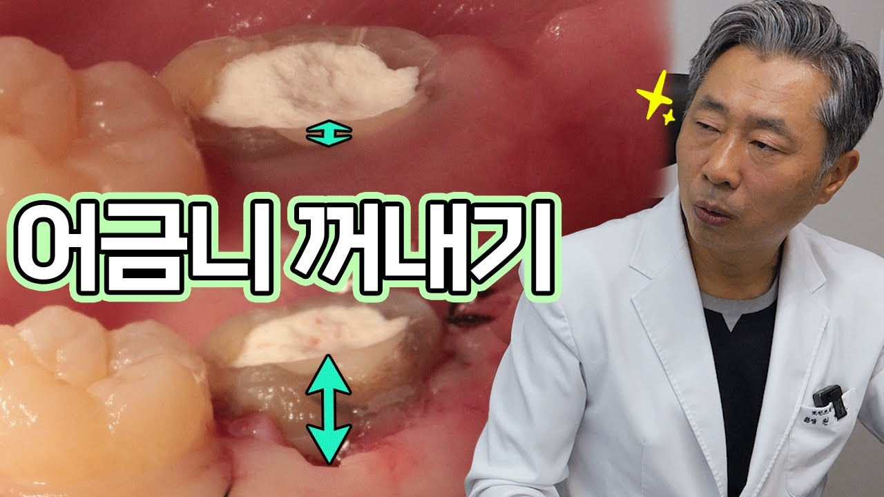 잇몸 속에 파묻힌 어금니 쑤욱 자라나게 하는 법