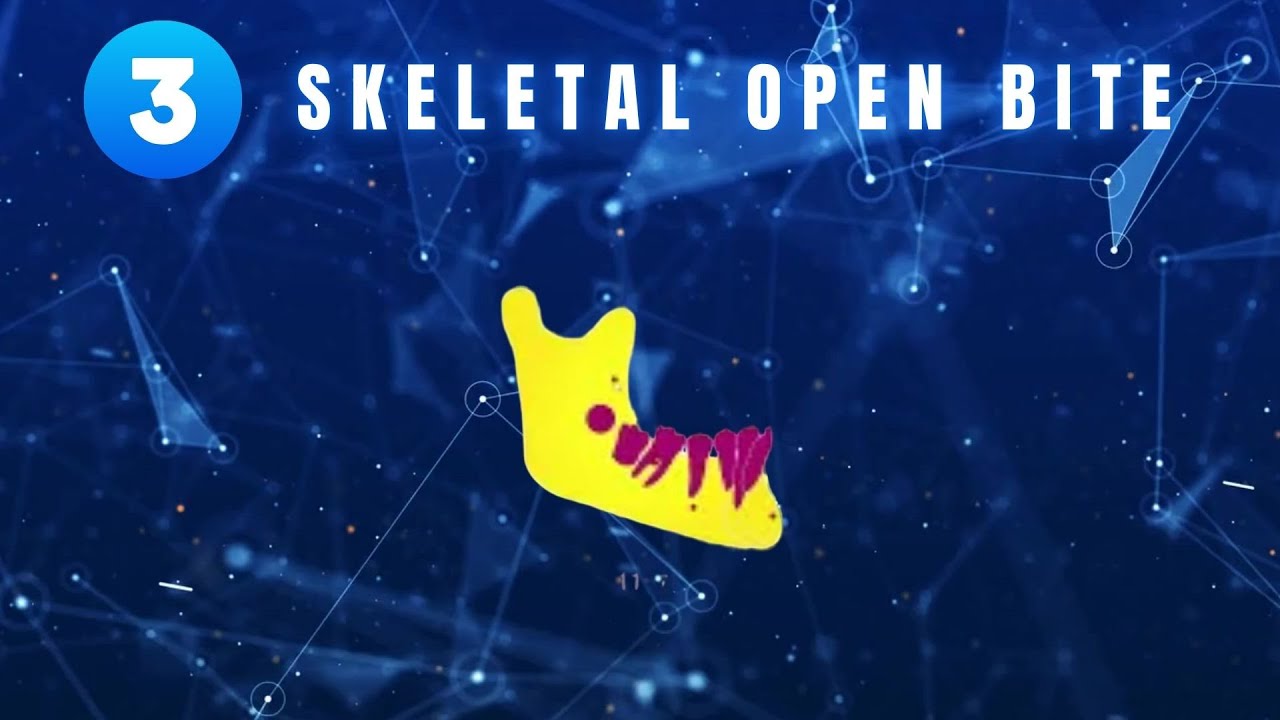 Dr. Chun's case review(3) l Skeletal Open Bite