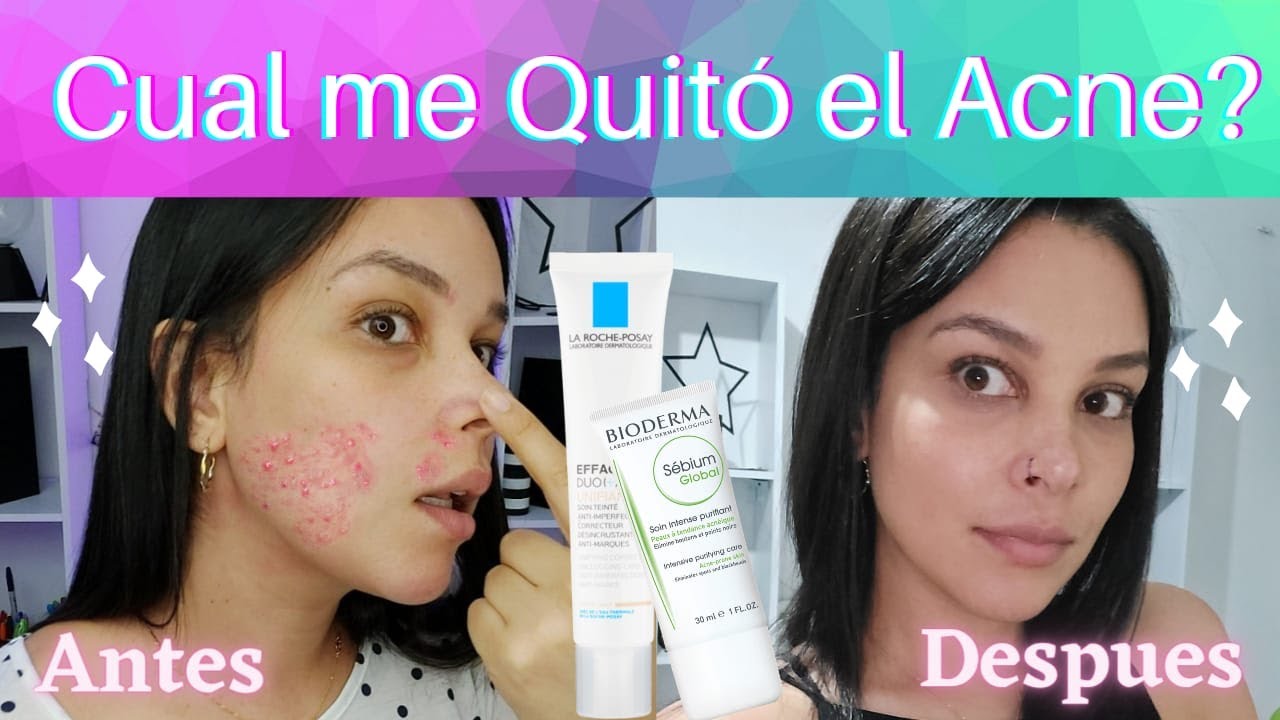 Cómo me Quito el Acné?: BIODERMA vs LA ROCHE POSAY