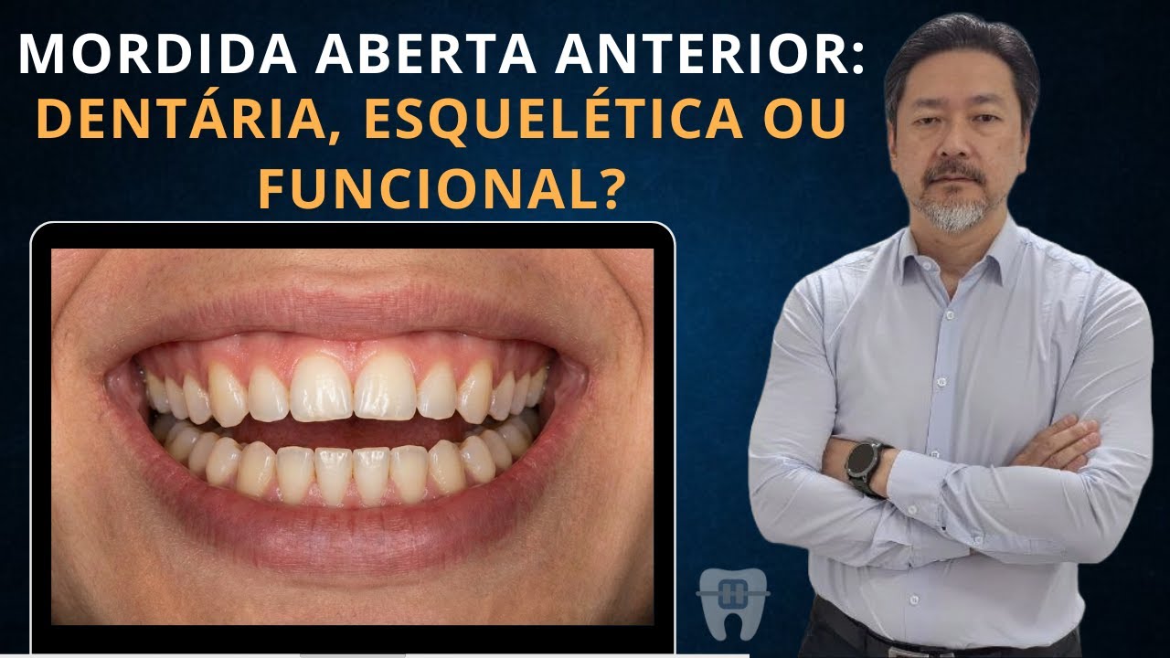 Tipos de Tratamento para Mordida Aberta Anterior #09