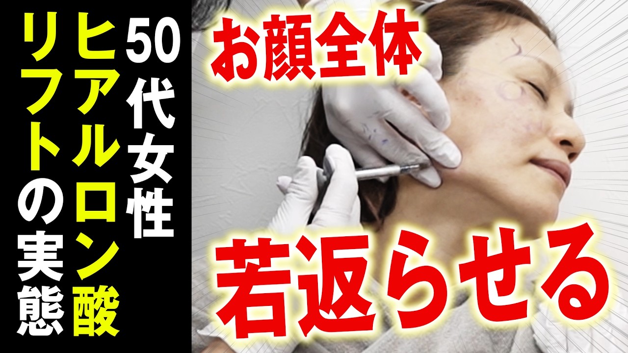 【自然に若返り】顔全体のたるみが気になる50代必見！ヒアルロン酸だけで若々しさを取り戻す方法
