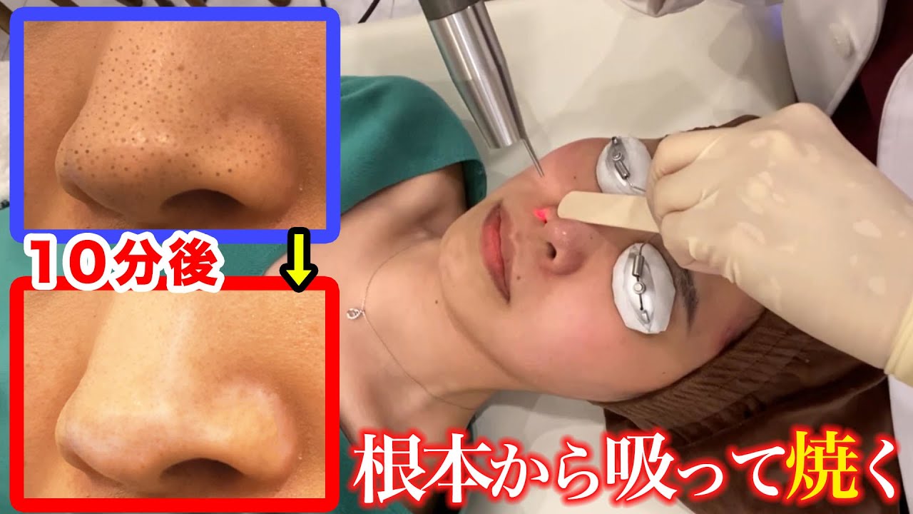 【いちご鼻】ブラックヘッド治療に潜入調査！毛穴黒ずみ角栓をごっそり取る吸引施術をガチレビュー（本気で完治したい人へ）