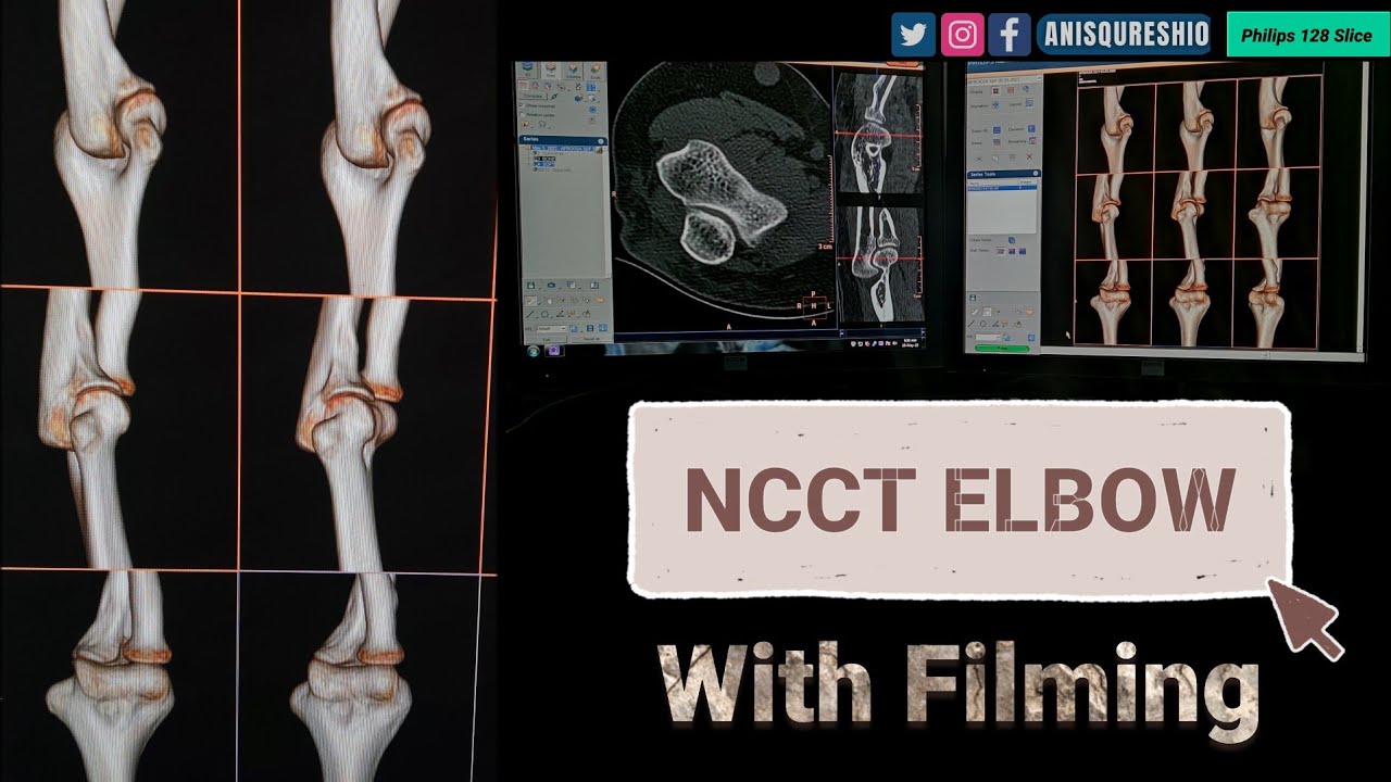 Ncct Elbow With Filming | By Anis Qureshi