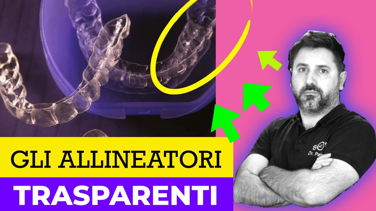 Aligner Allineatori Invisibili Secret Club spiegati da Dr Palmas
