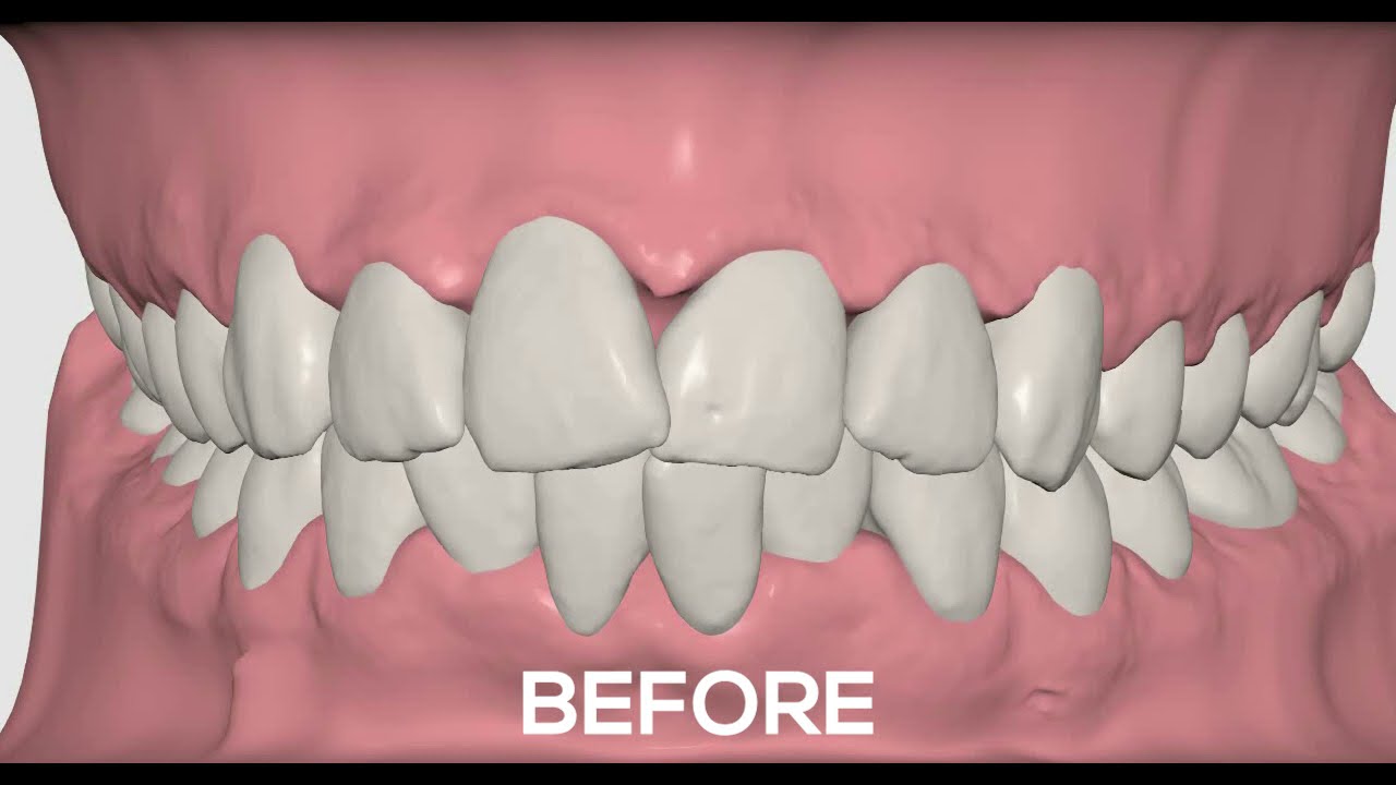CROWDING TREATMENT USING CLEAR ALIGNER