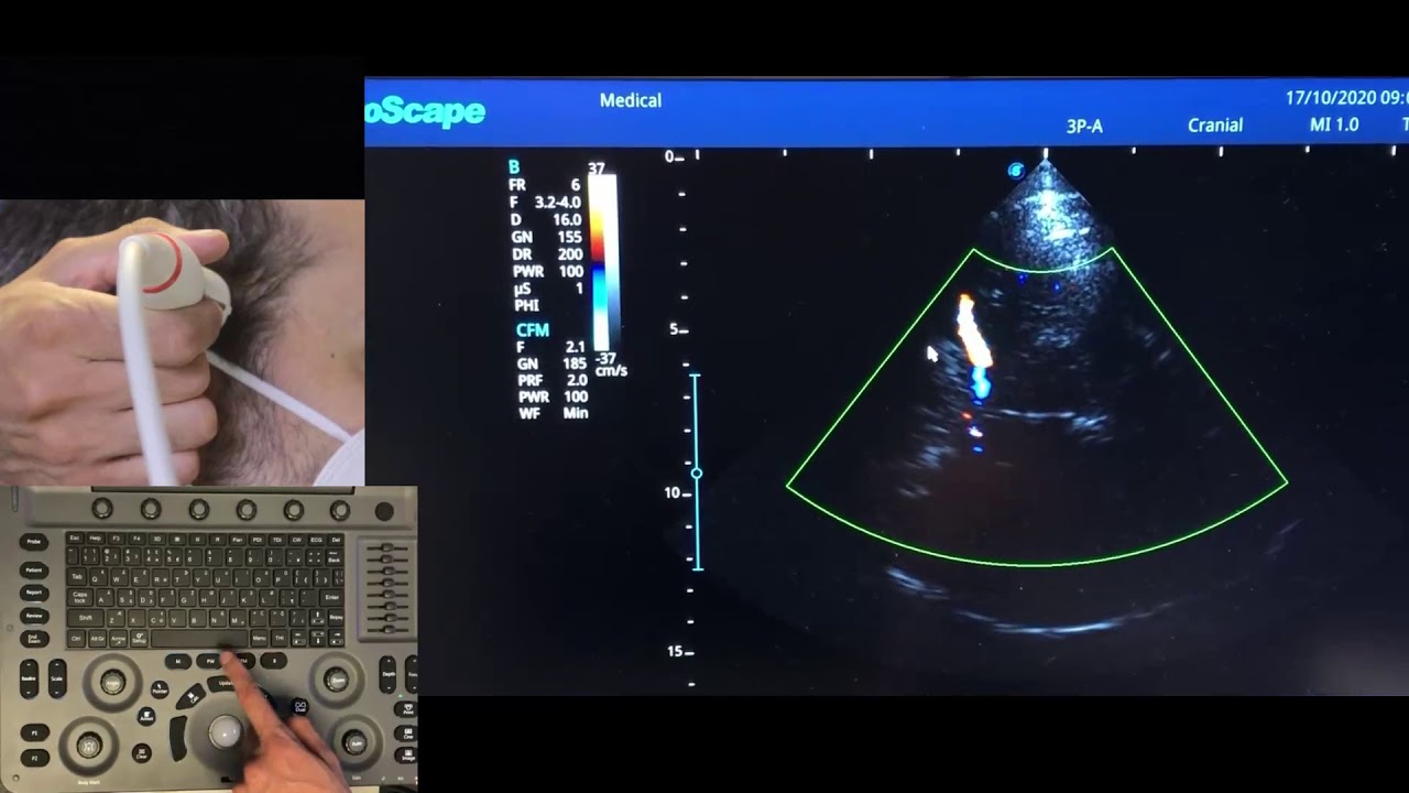 Tutorial básico de doppler transcraneal - Dr Gerardo Ruiz