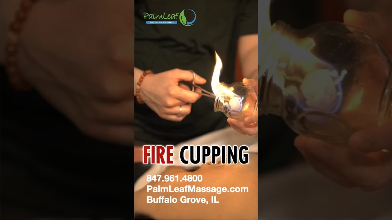 Fire Cupping Therapy | PalmLeaf Massage Buffalo Grove, IL