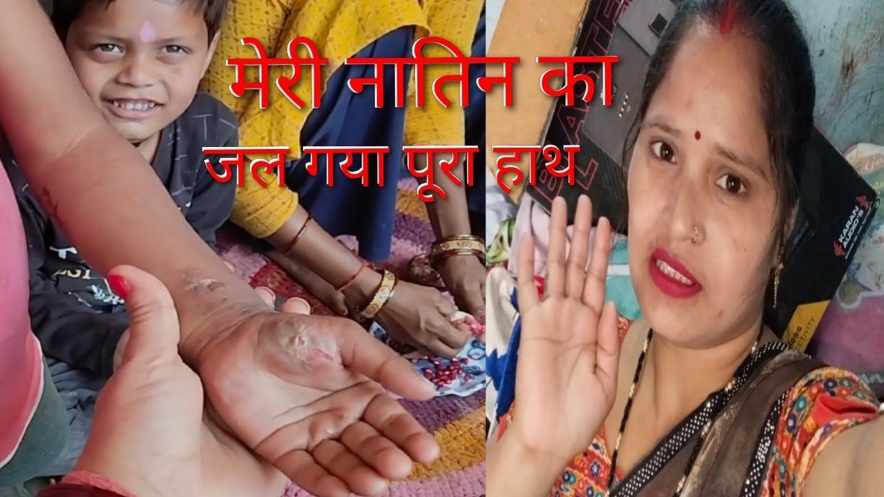 March 1, 2026 मेरी नातिन का जल गया पूरा हाथ 😱😭#seema #kumari 
