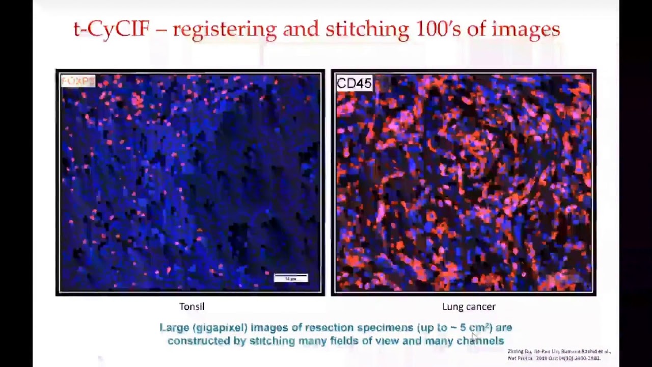 Multiplexed Imaging to Understand the High-Dimensional Pathology of Human Cancer