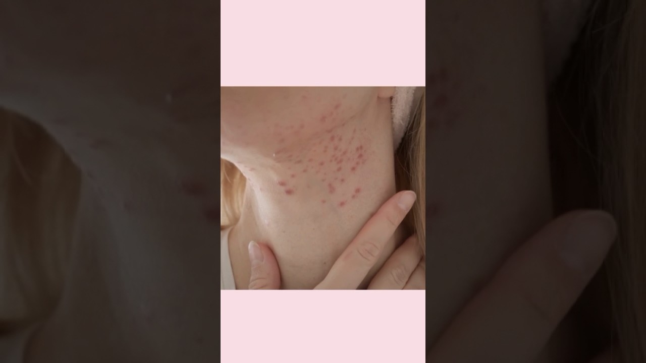 How I keep my skin clear during menopause