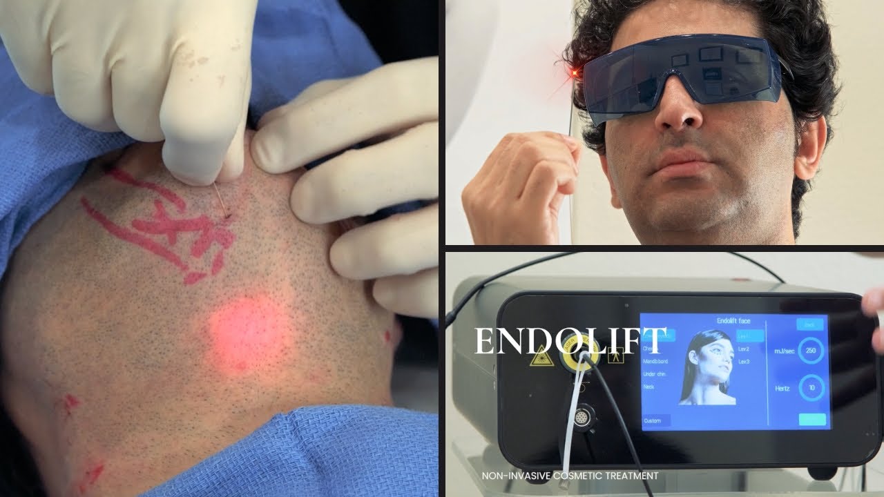 Endolift Laser Treatment, Orange County, CA   PCH MedSpa