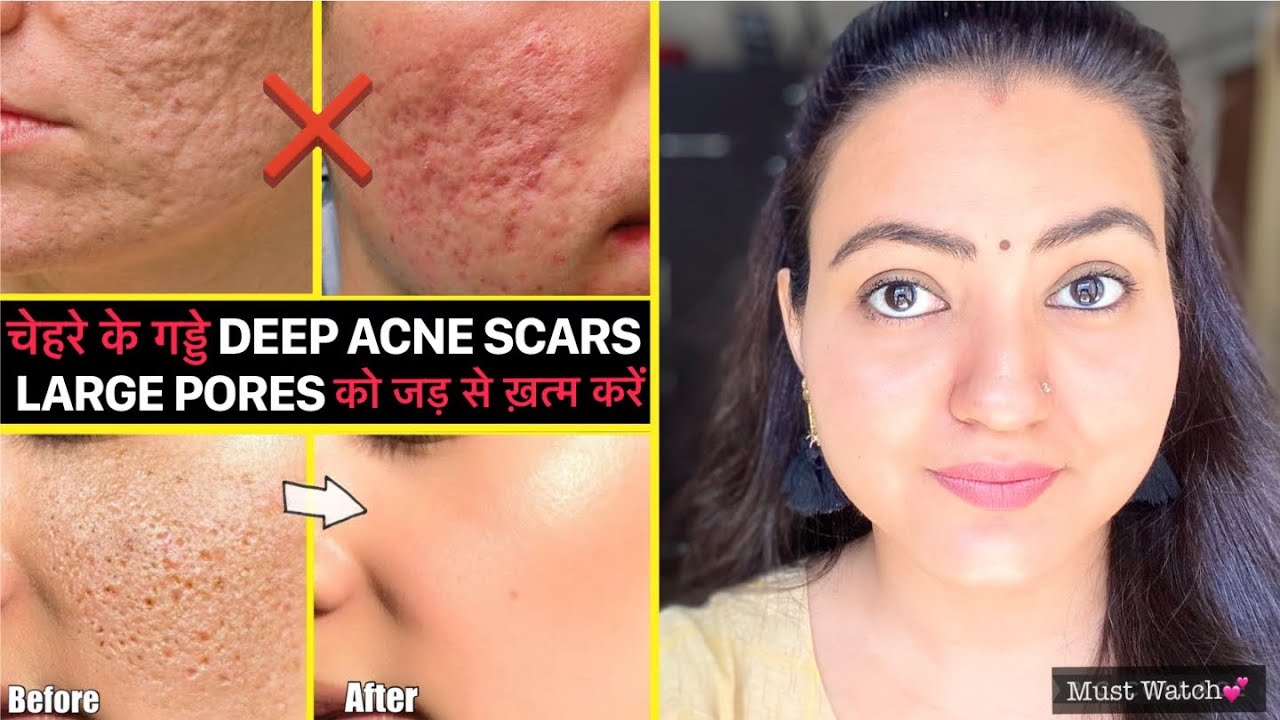 कितने भी पुराने गड्ढे LARGE PORES, DEEP ACNE SCARS हों चेहरे पर, इस Remedy से होगा 100% फायदा